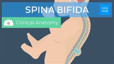 Spina Bifida: Types, Tests, Treatment & Prevention